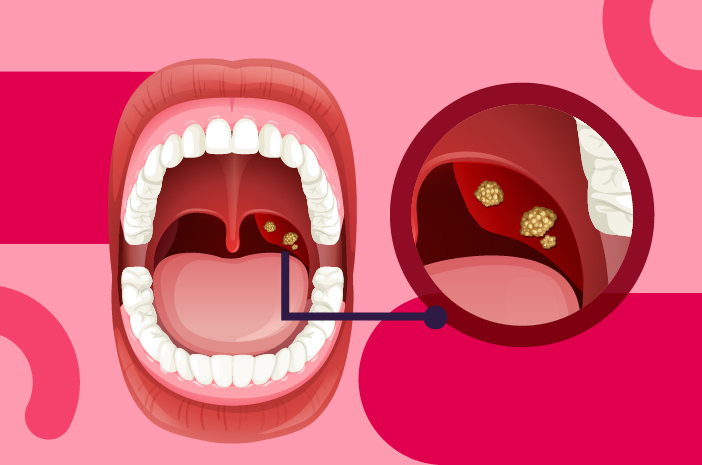 Kenali Batu Amandel Penyebab, Gejala & Solusi